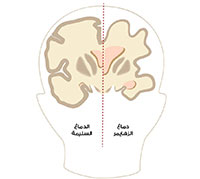 الزهايمر.jpg