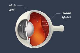 علاج-انفصال-الشبكية.jpeg