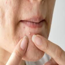 علاج-حبوب-الذقن-للنساء.jpeg