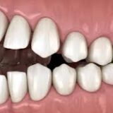 تطابق-الاسنان