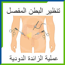 عملية-الزائدة-بالمنظار.jpeg