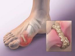 علاج-سريع-لالتهاب-المفاصل.jpg